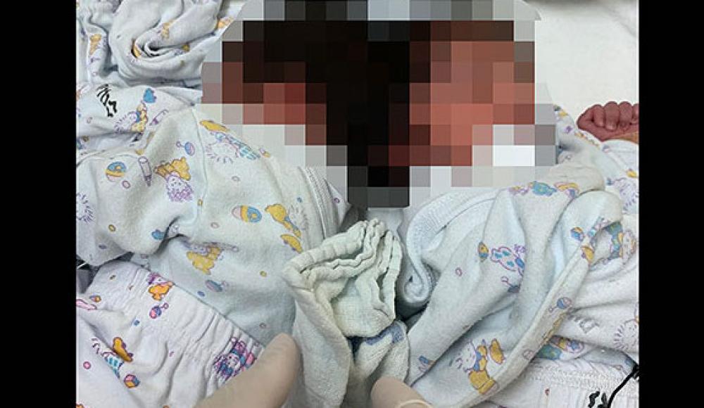 В Израиле впервые проведена операция по разделению сросшихся головами сиамских близнецов