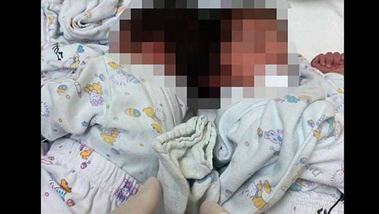 В Израиле впервые проведена операция по разделению сросшихся головами сиамских близнецов