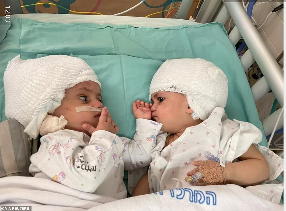 47555045-9961771-One_year_old_twin_Israeli_girls_who_were_born_conjoined_at_the_h-a-20_1630914483486.jpg