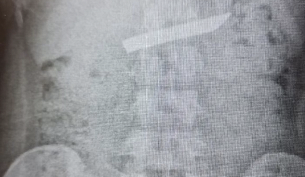 На севере Израиля врачи спасли проглотившую нож 18-летнюю пациентку